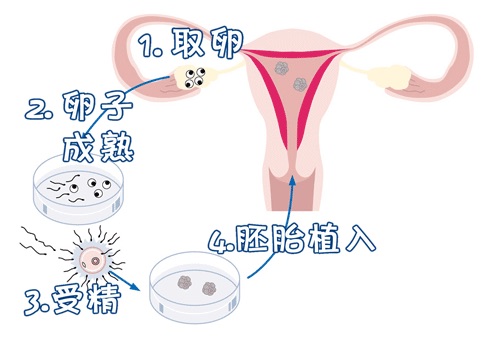 染色体易位